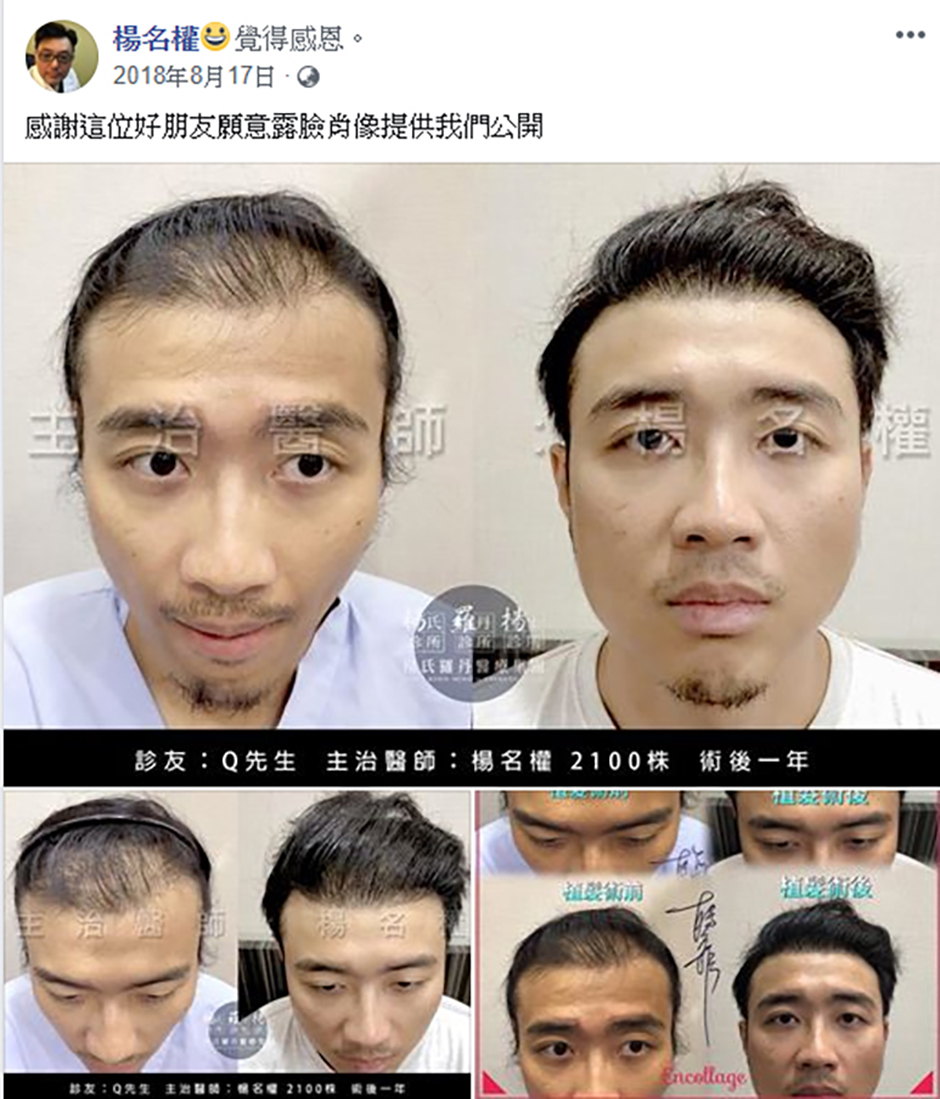 植髮,六合一三階段雄性禿治療 禿頭,楊氏羅丹,楊名權,掉髮